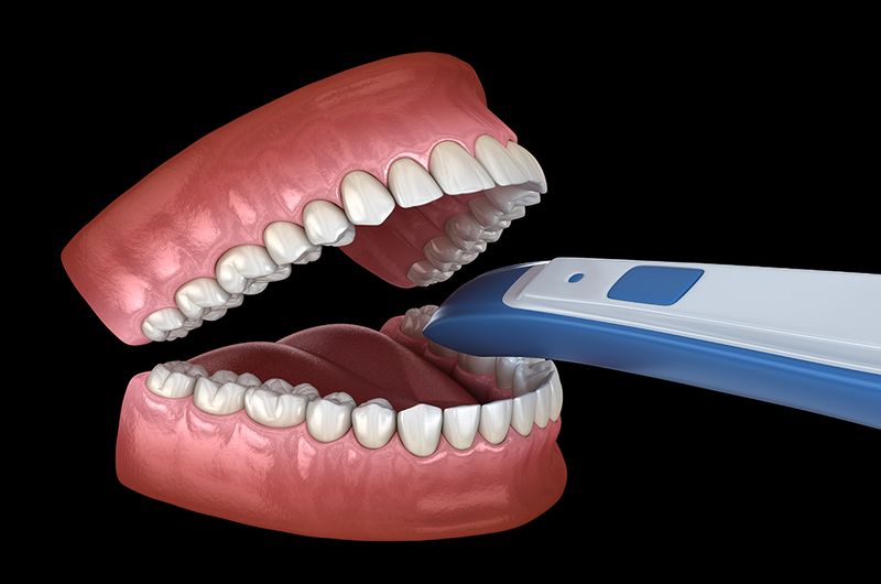 Digitaler Intraoralscan (Illustration)