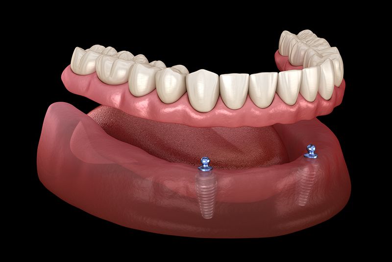 Implantatgestützte Prothese (Illustration)