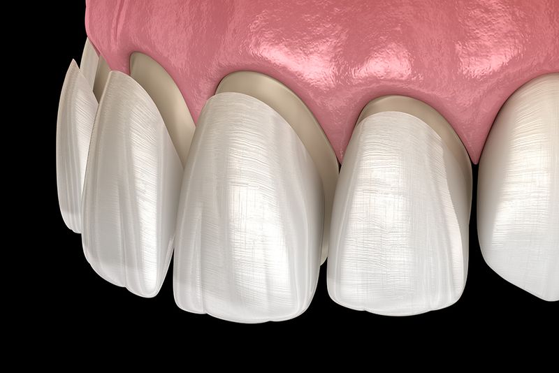 Veneers auf Frontzähnen (Illustration)